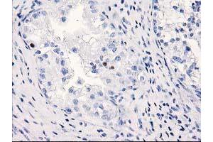 Immunohistochemical staining of paraffin-embedded Adenocarcinoma of Human ovary tissue using anti-C1orf50 mouse monoclonal antibody. (C1ORF50 Antikörper)