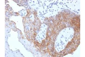 IHC testing of FFPE human tongue carcinoma with CD44v9 antibody (clone CD44v9/1459). (CD44v9 Antikörper)