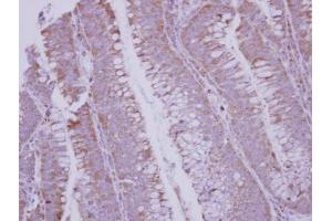 IHC-P Image Immunohistochemical analysis of paraffin-embedded human colon carcinoma, using BMP10, antibody at 1:250 dilution. (BMP10 Antikörper  (C-Term))