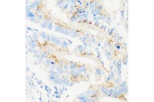 Immunohistochemistry of paraffin-embedded Human colon carcinoma using M Rabbit pAb (ABIN7268390) at dilution of 1:100 (40x lens). (MAN1A2 Antikörper  (AA 60-180))