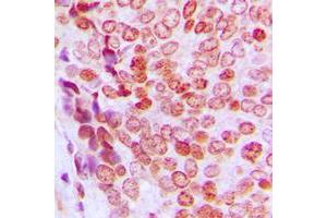 Immunohistochemical analysis of p21 (pT145) staining in human prostate cancer formalin fixed paraffin embedded tissue section.