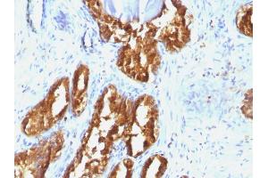 Formalin-fixed, paraffin-embedded human Prostate Carcinoma stained with PSAP Mouse Monoclonal Antibody (ACPP/1338). (ACPP Antikörper)