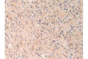 IHC-P analysis of Human Glioma Tissue, with DAB staining. (OIT3 Antikörper  (AA 297-506))