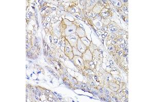 Immunohistochemistry of paraffin-embedded human esophageal cancer using SEMF Rabbit pAb (ABIN6132835, ABIN6147521, ABIN6147522 and ABIN6214683) at dilution of 1:200 (40x lens).