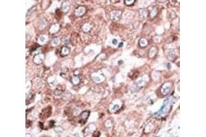 IHC analysis of FFPE hepatocarcinoma cancer tissue stained with the Bak antibody (BAK1 Antikörper  (AA 56-91))