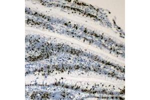 Immunohistochemical analysis of c-Myc staining in human colon cancer formalin fixed paraffin embedded tissue section.