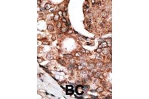 Formalin-fixed and paraffin-embedded human cancer tissue reacted with the primary antibody, which was peroxidase-conjugated to the secondary antibody, followed by DAB staining. (MLLT6 Antikörper  (C-Term))