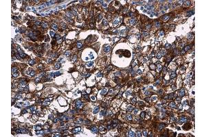 IHC-P Image VCAM1 / CD106 antibody detects VCAM1 / CD106 protein at cell membrane in human endometrial carcinoma by immunohistochemical analysis. (VCAM1 Antikörper)