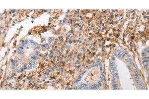 Immunohistochemistry of paraffin-embedded Human colon cancer using INA Polyclonal Antibody at dilution of 1:50 (INA Antikörper)