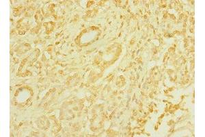 Immunohistochemistry of paraffin-embedded human pancreatic cancer using ABIN7171535 at dilution of 1:100 (TAS1R3 Antikörper  (AA 400-570))