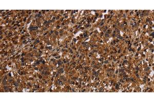 Immunohistochemistry of paraffin-embedded Human liver cancer tissue using MAGEC2 Polyclonal Antibody at dilution 1:40 (MAGEC2 Antikörper)