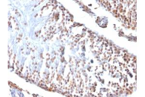 Immunohistochemistry (IHC) image for anti-Wilms Tumor 1 (WT1) (AA 1-181) antibody (ABIN6940900)