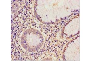 Immunohistochemistry of paraffin-embedded human colon cancer using ABIN7152221 at dilution of 1:100 (EIF6 Antikörper  (AA 1-245))