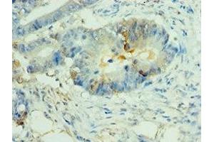 Immunohistochemistry of paraffin-embedded human colon cancer using ABIN7160825 at dilution of 1:100 (NLRP2 Antikörper  (AA 1-220))
