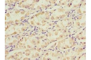 Immunohistochemistry of paraffin-embedded human gastric cancer using ABIN7149377 at dilution of 1:100 (NT5C3 Antikörper  (AA 37-336))