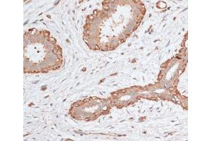 Immunohistochemistry of paraffin-embedded Human breast cancer using ABCC5 Polyclonal Antibody at dilution of 1:100 (40x lens). (ABCC5 Antikörper)