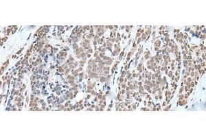 Immunohistochemistry of paraffin-embedded Human thyroid cancer tissue using WTAP Polyclonal Antibody at dilution of 1:35(x200) (WTAP Antikörper)