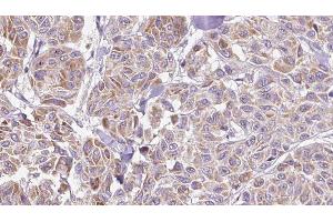 ABIN6278894 at 1/100 staining Human Melanoma tissue by IHC-P. (IL17C Antikörper  (Internal Region))