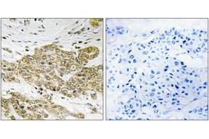 Immunohistochemistry analysis of paraffin-embedded human breast carcinoma, using p53 (Phospho-Ser6) Antibody. (p53 Antikörper  (pSer6))