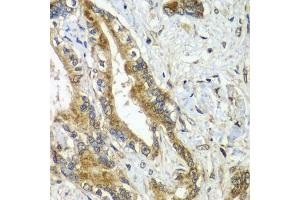 Immunohistochemistry of paraffin-embedded human liver cancer using CDC16 antibody  at dilution of 1:100 (40x lens). (CDC16 Antikörper  (AA 371-620))