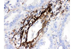 MGP was detected in paraffin-embedded sections of human lung cancer tissues using rabbit anti- MGP Antigen Affinity purified polyclonal antibody (Catalog # ) at 1 µg/mL.
