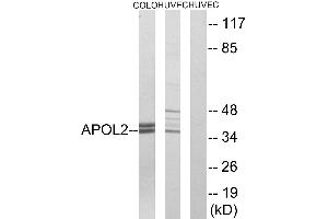 Immunohistochemistry analysis of paraffin-embedded human cervix carcinoma tissue using APOL2 antibody. (Apolipoprotein L 2 Antikörper)