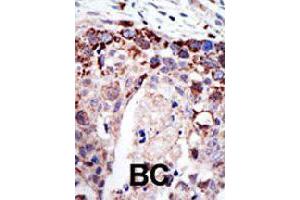 Formalin-fixed and paraffin-embedded human cancer tissue reacted with ATXN3 polyclonal antibody  , which was peroxidase-conjugated to the secondary antibody, followed by AEC staining. (Ataxin 3 Antikörper  (AA 29-59))