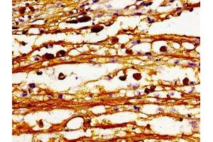 Immunohistochemistry of paraffin-embedded human melanoma using ABIN7147475 at dilution of 1:100 (CERS6 Antikörper  (AA 324-392))