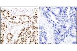 Immunohistochemistry analysis of paraffin-embedded human breast carcinoma tissue, using Elk1 (Ab-417) Antibody. (ELK1 Antikörper  (AA 379-428))