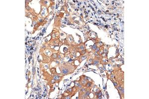 Immunohistochemistry of paraffin-embedded human lung cancer using eIF2C3 Rabbit mAb (ABIN7267039) at dilution of 1:100 (40x lens). (EIF2C3 Antikörper)