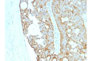 Formalin-fixed, paraffin-embedded human Colon Carcinoma stained with MAML2 Monoclonal Antibody (MAML2/1302). (MAML2 Antikörper)
