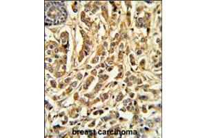 Formalin-fixed and paraffin-embedded human breast carcinoma reacted with CYP21A2 Antibody , which was peroxidase-conjugated to the secondary antibody, followed by DAB staining. (CYP21A2 Antikörper  (AA 216-246))