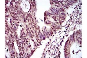 Immunohistochemical analysis of paraffin-embedded rectum cancer tissues using PIWIL4 mouse mAb with DAB staining. (PIWIL4 Antikörper  (AA 304-434))
