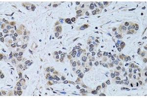 Immunohistochemistry of paraffin-embedded Human liver cancer using SIN3A Polyclonal Antibody at dilution of 1:100 (40x lens). (SIN3A Antikörper)