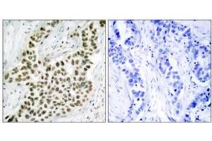 Immunohistochemical analysis of paraffin- embedded human breast carcinoma tissue using Histone H2A. (H2AFX Antikörper)