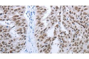 Immunohistochemistry of paraffin-embedded Human ovarian cancer tissue using RBMS1 Polyclonal Antibody at dilution 1:30 (RBMS1 Antikörper)