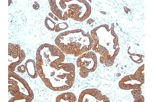 Formalin-fixed, paraffin-embedded human Colon Carcinoma stained with Cytokeratin 18 Mouse Monoclonal Antibody (DE-K18). (Cytokeratin 18 Antikörper)