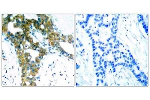 Immunohistochemical analysis of paraffin-embedded human breast carcinoma tissue, using PAK1/PAK2/PAK3 (Ab-423/402/421) antibody (E021169). (PAK1/2/3 Antikörper)