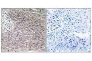 Immunohistochemistry analysis of paraffin-embedded human cervix carcinoma tissue using CHSS2 antibody. (CHPF Antikörper)