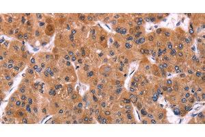 Immunohistochemistry of paraffin-embedded Human liver cancer using ERP29 Polyclonal Antibody at dilution of 1:40 (ERP29 Antikörper)