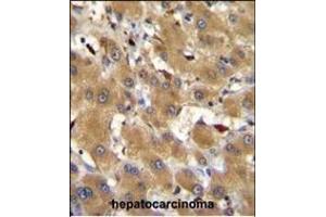 HPR Antibody (Center) (ABIN655063 and ABIN2844693) immunohistochemistry analysis in formalin fixed and paraffin embedded human hepatocarcinoma followed by peroxidase conjugation of the secondary antibody and DAB staining. (HPR Antikörper  (AA 212-240))