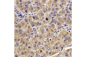 Immunohistochemical analysis of Tropomodulin-4 staining in human liver cancer formalin fixed paraffin embedded tissue section. (Tropomodulin 4 Antikörper)