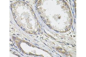 Immunohistochemistry of paraffin-embedded Human prostate cancer using UBE2S Polyclonal Antibody at dilution of 1:100 (40x lens). (UBE2S Antikörper)