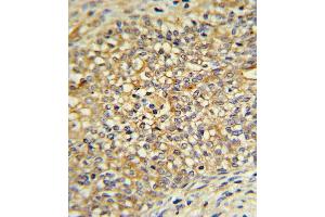 UDB17 Antibody (Center) (ABIN390399 and ABIN2840791) IHC analysis in formalin fixed and paraffin embedded human Prostate carcinoma followed by peroxidase conjugation of the secondary antibody and DAB staining. (UGT2B17 Antikörper  (AA 119-147))