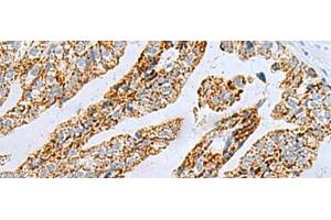 Immunohistochemistry of paraffin-embedded Human gastric cancer tissue using PYCR2 Polyclonal Antibody at dilution of 1:40(x200) (PYCR2 Antikörper)