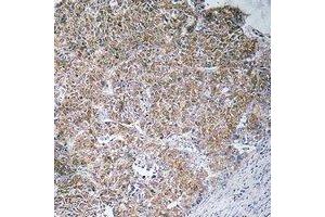 Immunohistochemical analysis of CHST13 staining in human liver cancer formalin fixed paraffin embedded tissue section. (CHST13 Antikörper)