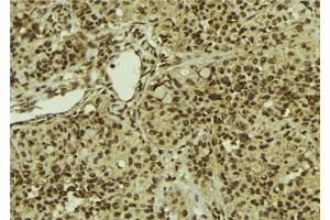 ABIN6279887 at 1/100 staining Human breast cancer tissue by IHC-P.