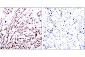 Immunohistochemistry analysis of paraffin-embedded human breast carcinoma, using ATF2 (Phospho-Thr73 or 55) Antibody. (ATF2 Antikörper  (pThr73))