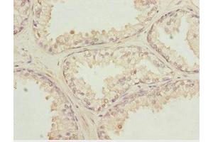 Immunohistochemistry of paraffin-embedded human prostate cancer using ABIN7156132 at dilution of 1:100 (KPNA6 Antikörper  (AA 277-536))