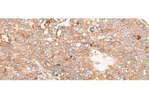 Immunohistochemistry of paraffin-embedded Human liver cancer tissue using SIGLECL1 Polyclonal Antibody at dilution of 1:65(x200) (SIGLECL1 Antikörper)